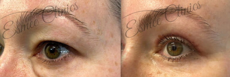 Before and After img